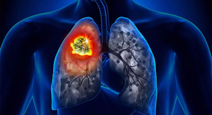 戒烟可以促进健康细胞的生长并消除导致肺癌的突变