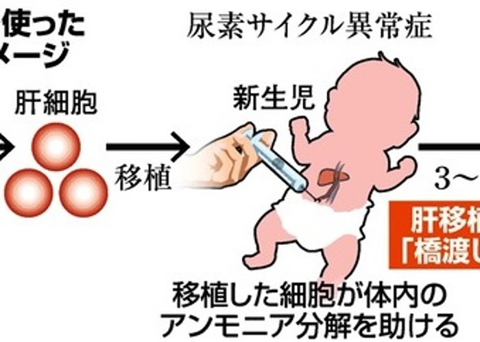 肝脏细胞移植至婴儿肝脏血管示意图。