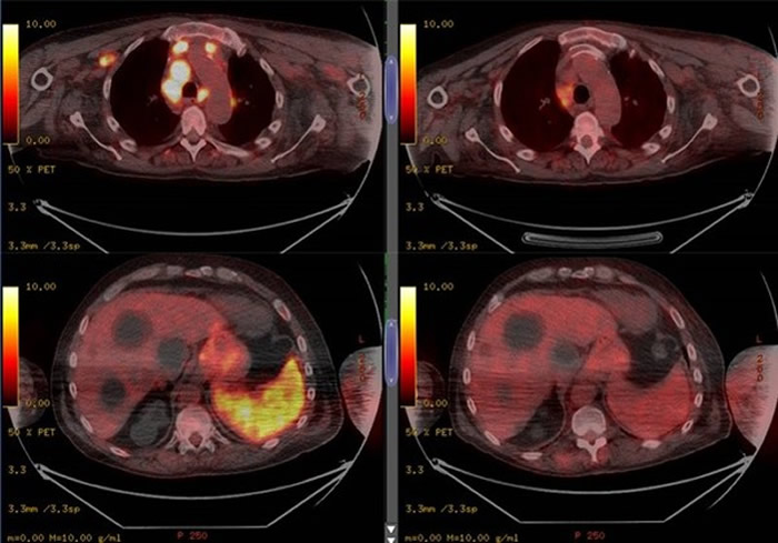 оԱƲ¹ڲ忹߷ӦͼΪȾߺӰͼBritish Journal of Haematology