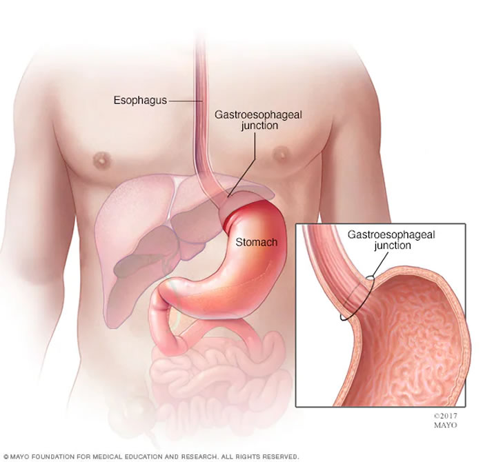 11月是胃癌宣传月：有关胃癌治疗与研究的最新进展