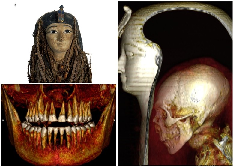 阿孟霍特普一世的颅骨（右图）及牙齿结构（左下图）完整。