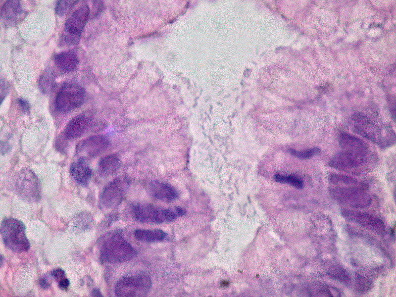 幽门螺杆菌首次被列为明确致癌物 幽门螺杆菌感染症状表现