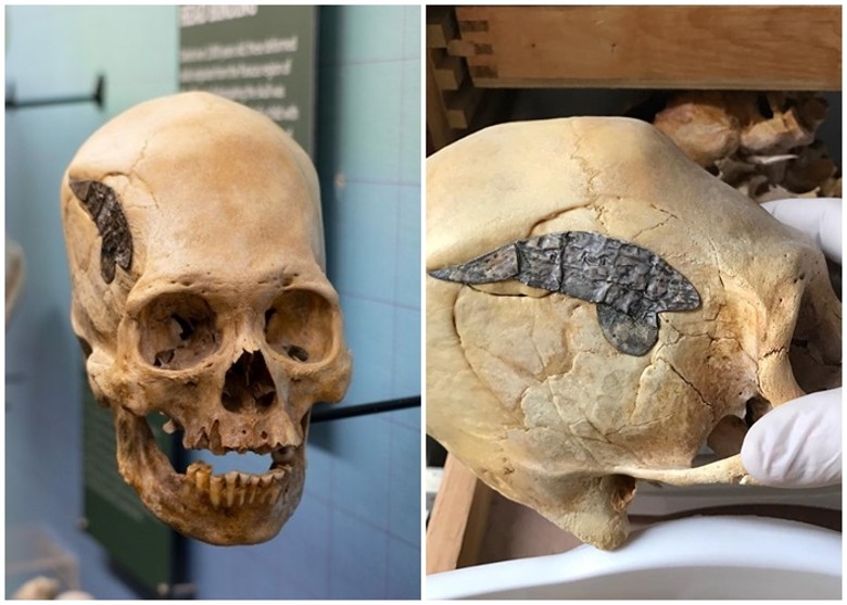 2000年历史的秘鲁战士头骨镶金属 或属古代手术例子