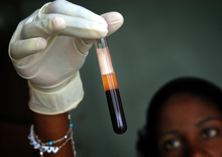 美国白血病女患者获移植干细胞 体内HIV消失