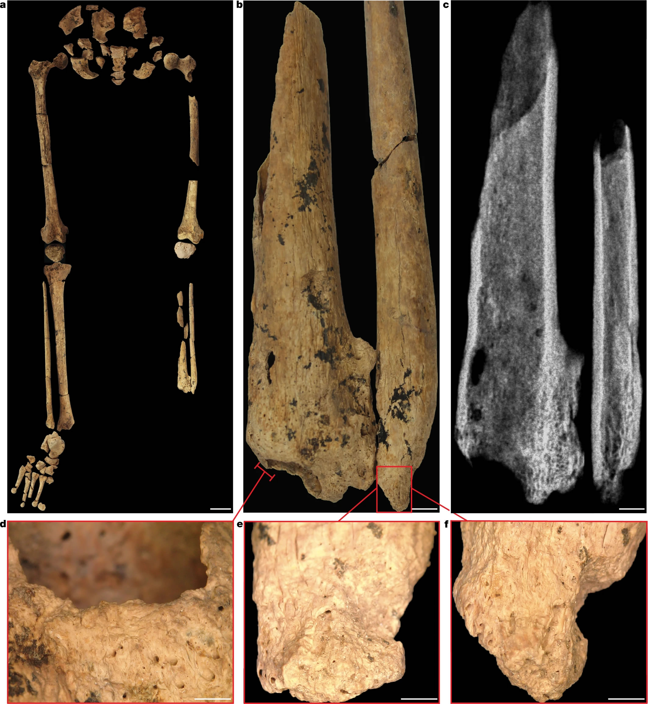 该个体孩童时左腿下部被截肢，但仍活到了刚刚成年的时候，事件发生在31000年前的婆罗洲。图片来源：Jose Garcia