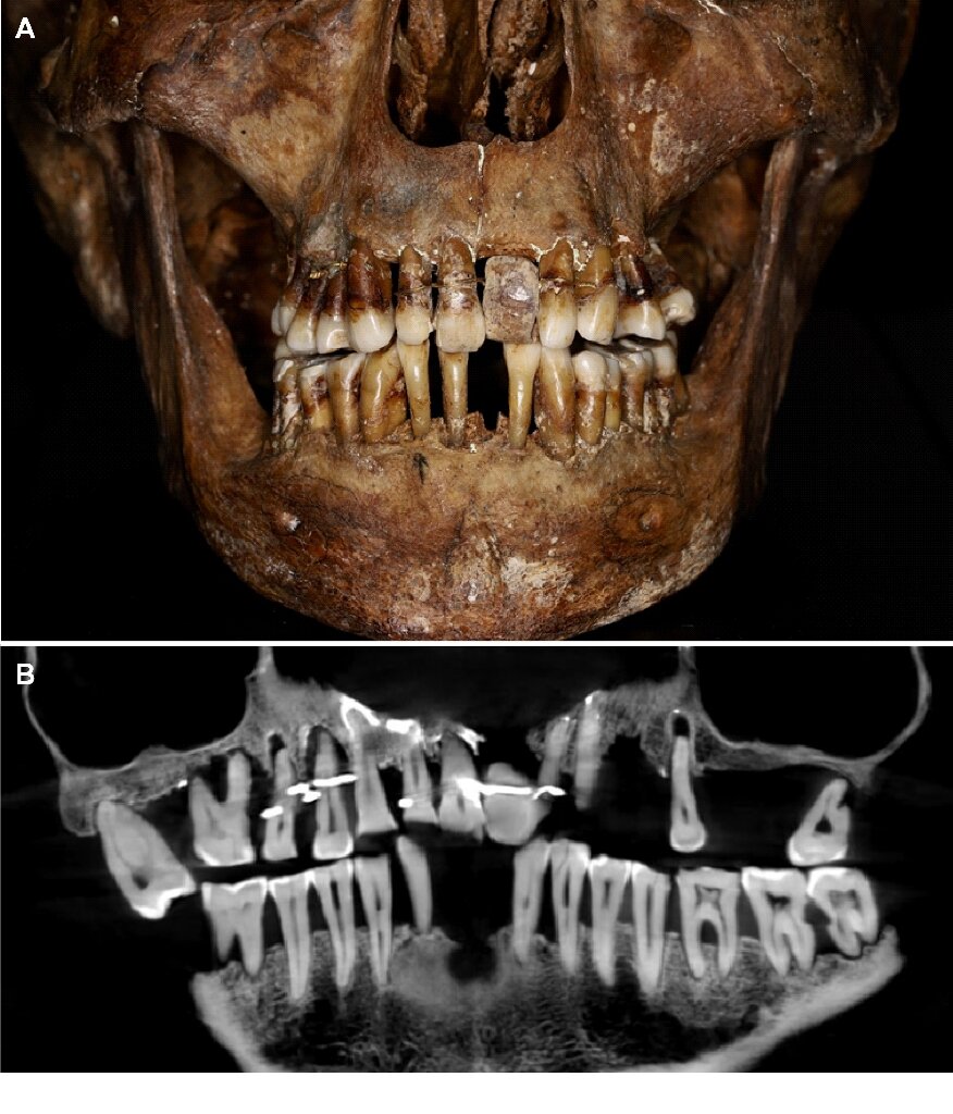 科学家一位法国贵族去世400年后发现她埋藏已久的秘密：用金线防止牙齿脱落