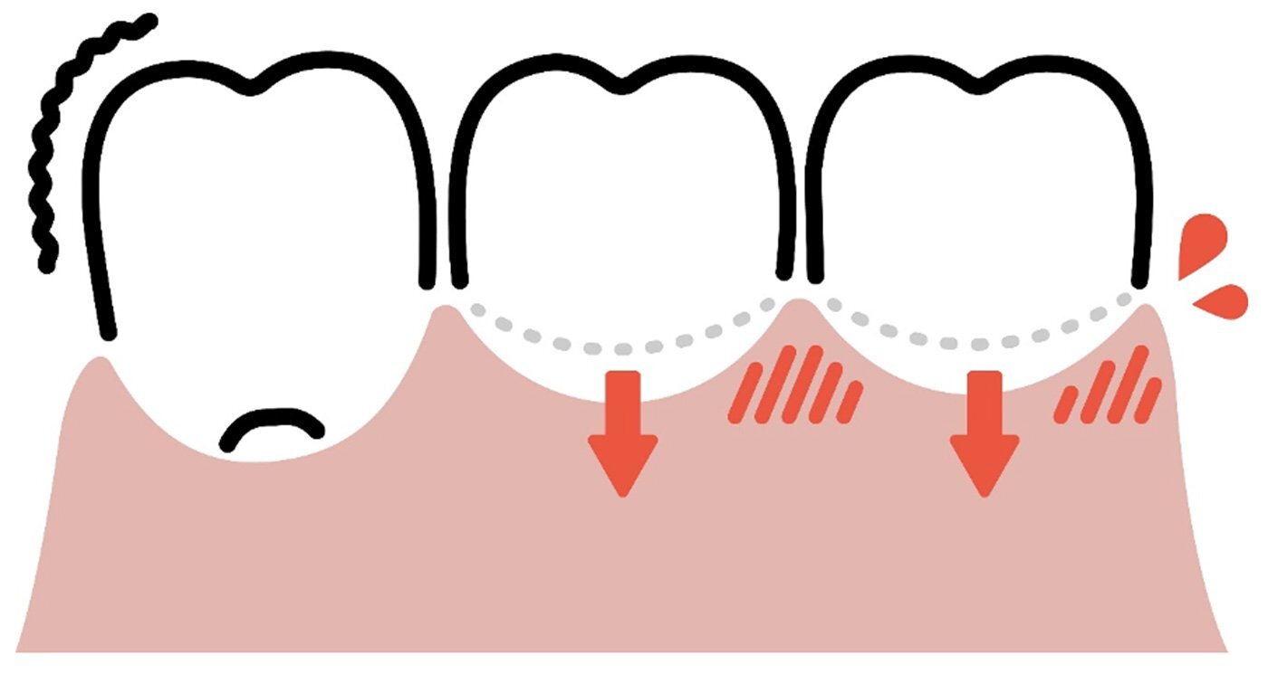 研究表明柔软的牙龈更容易发炎