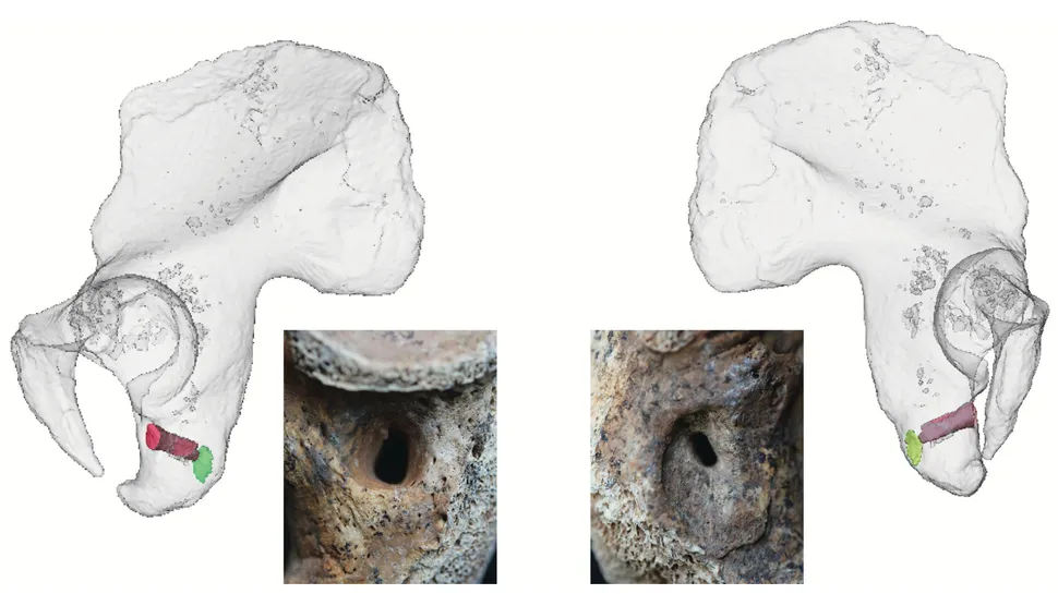 3D骨骼分析显示,精英凯尔特战士已治愈骨盆箭头伤