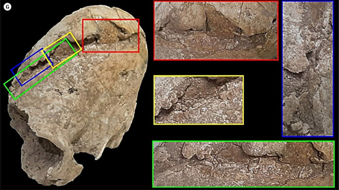 伊朗6200年前铜器时代古老的锥形头骨显示出致命创伤的迹象