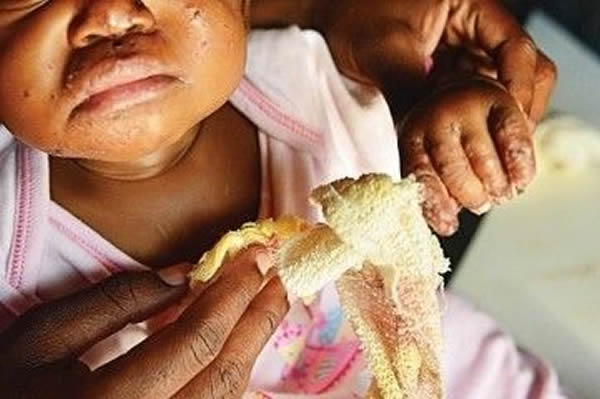 南非食人鼠啃食熟睡女婴