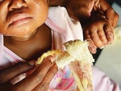 南非食人鼠啃食熟睡女婴