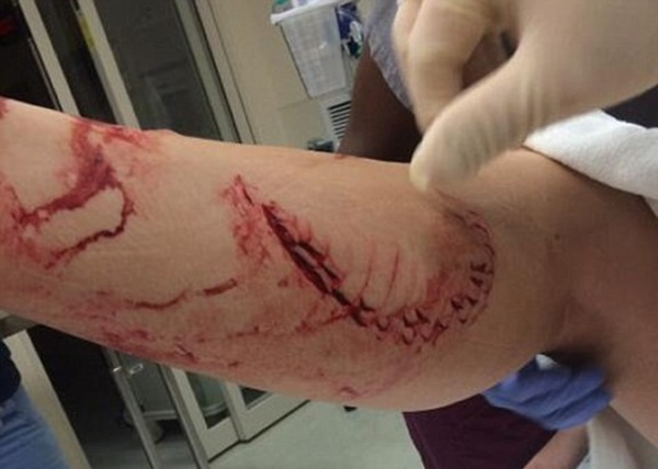 美国少女划船遇鲨鱼咬幸好大难不死