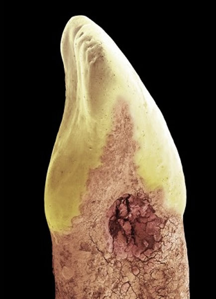 吓人:未有刷干净的牙齿表面电子显微镜图片