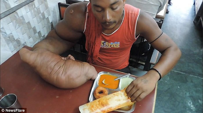 印度男子患局部巨人症右臂重20公斤被称魔鬼的孩子