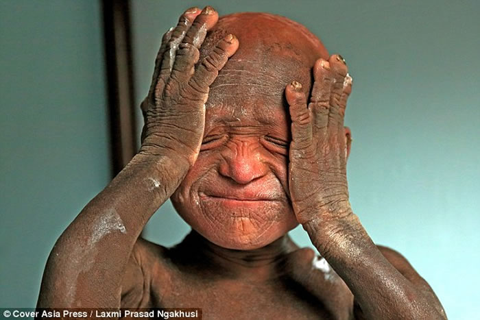 尼泊尔男童患鱼鳞癣不能说话行走如石头人