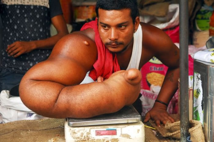 印度25岁男子患巨人症手臂比正常人大两倍被嘲魔鬼的孩子