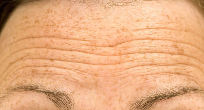 科学家发现可通过额偷皱纹数量预测患病和死亡风险