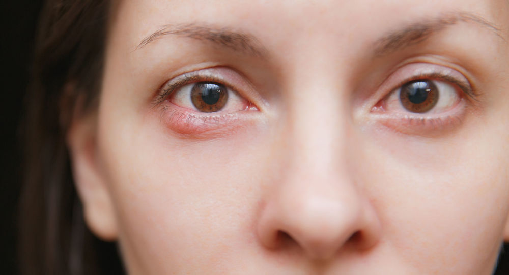 德米特里·迈丘克:眼睛发红可能是腺病毒或细菌感染以及干眼症的症状